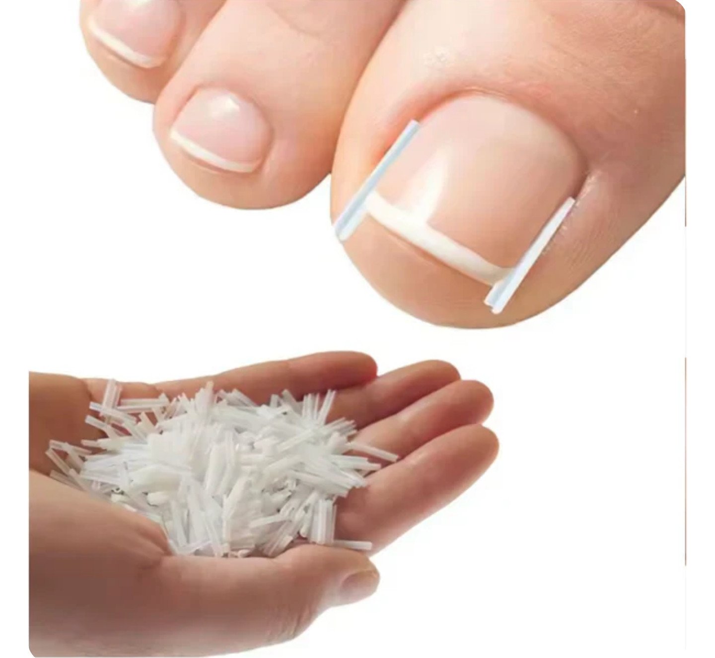 Toenail Correction Strips