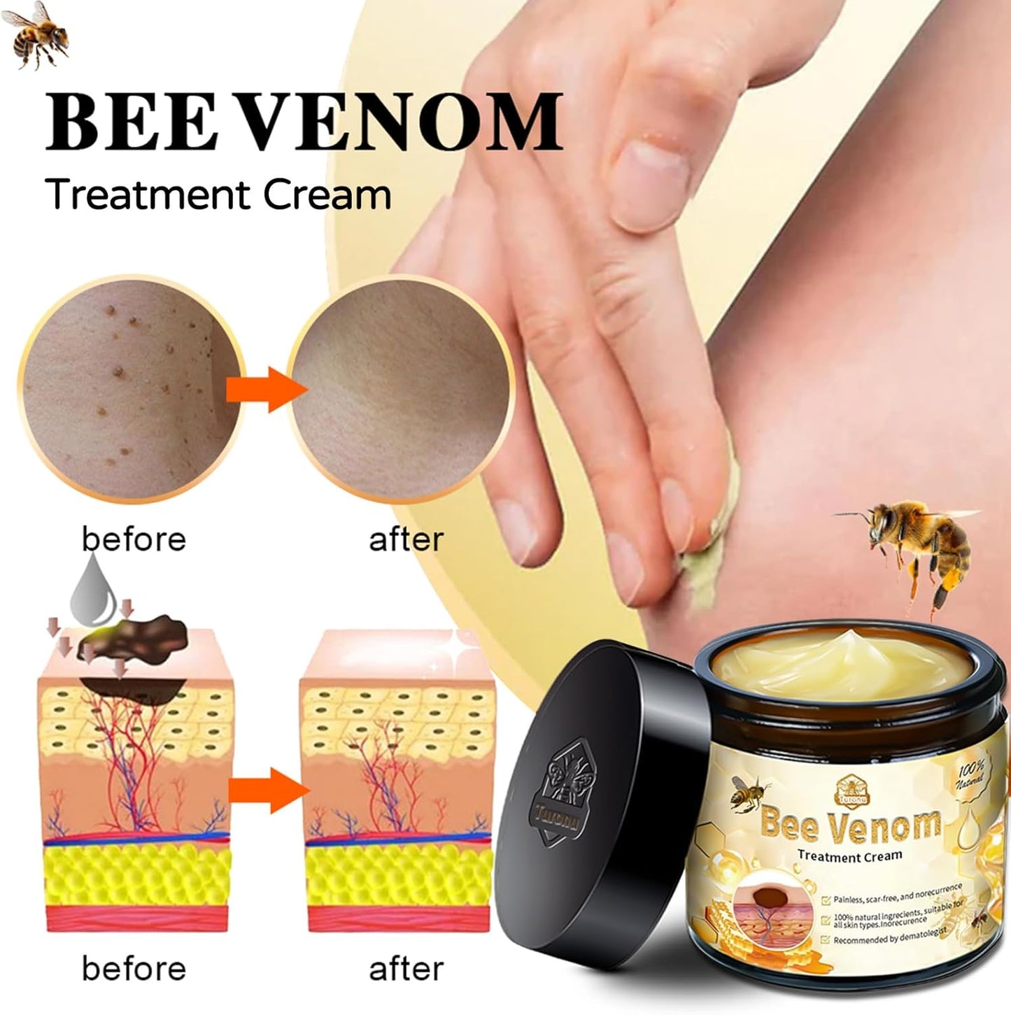 60g Bee Venom Wart Remover