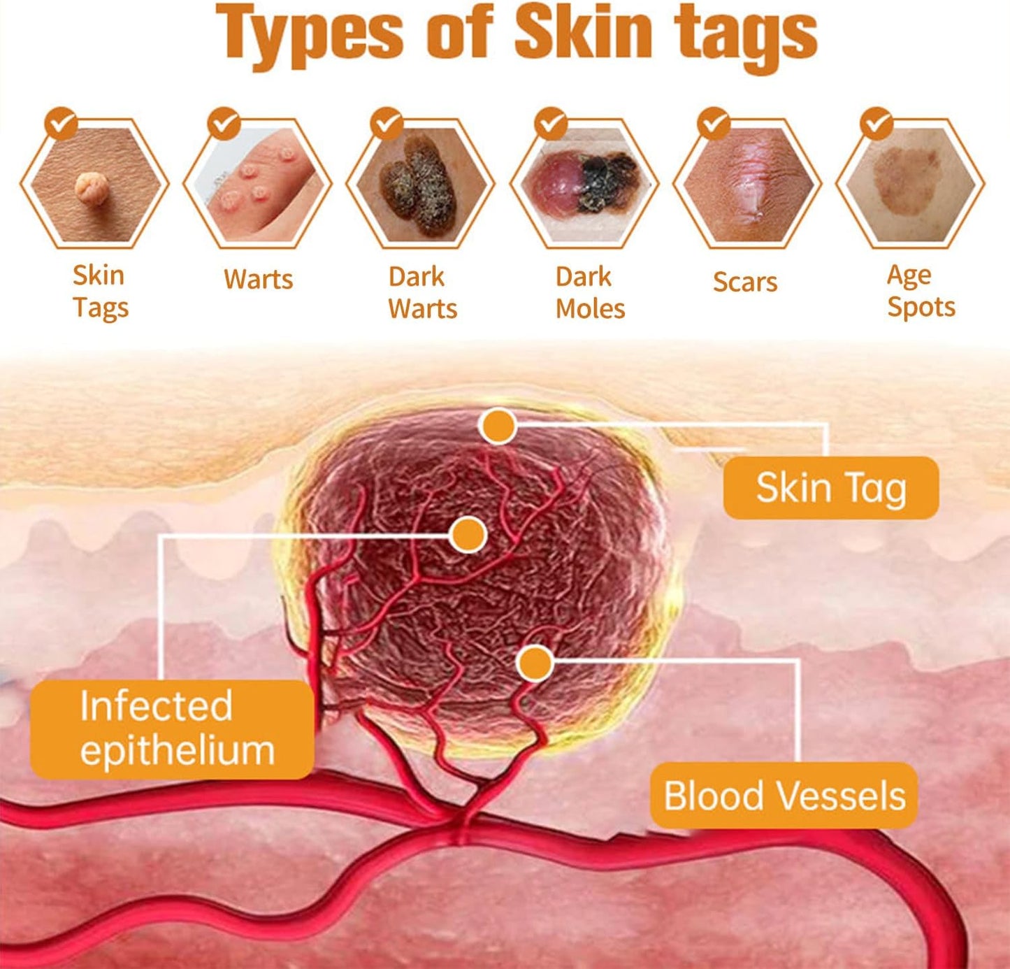 60g Bee Venom Wart Remover