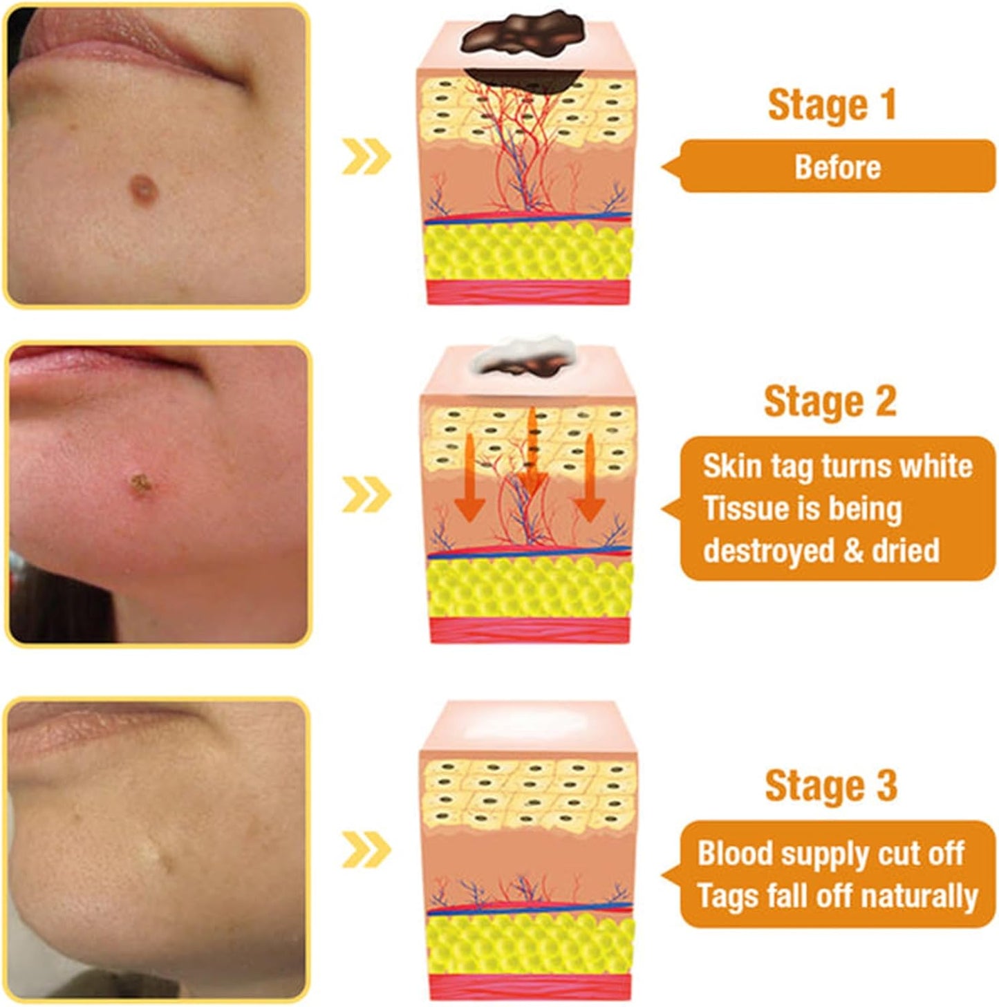 60g Bee Venom Wart Remover