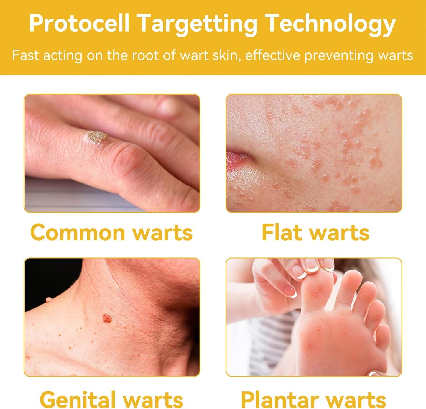 60g Bee Venom Wart Remover