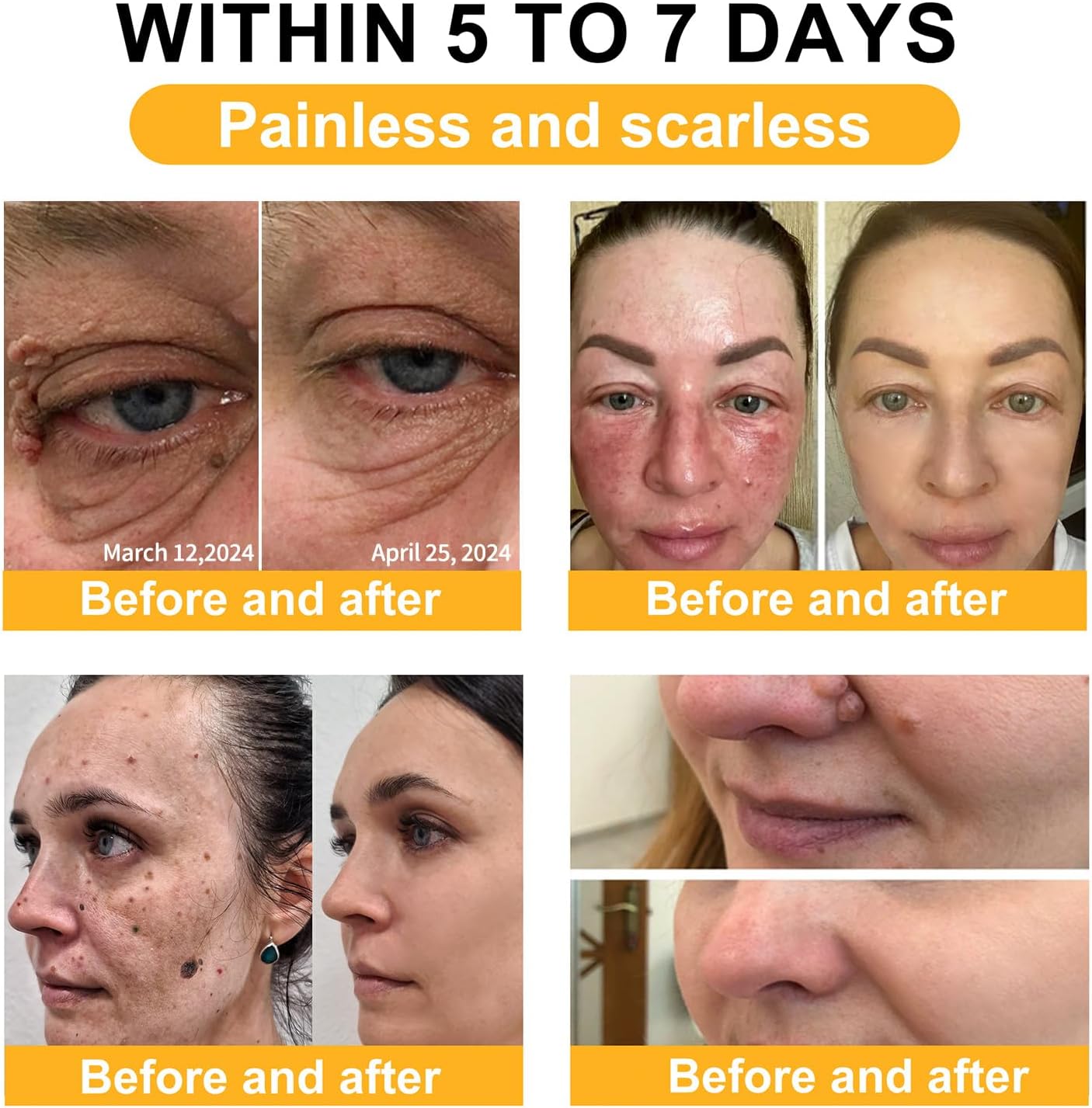 60g Bee Venom Wart Remover