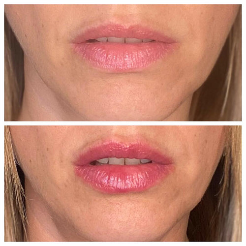 Volumising Lip Plumpler