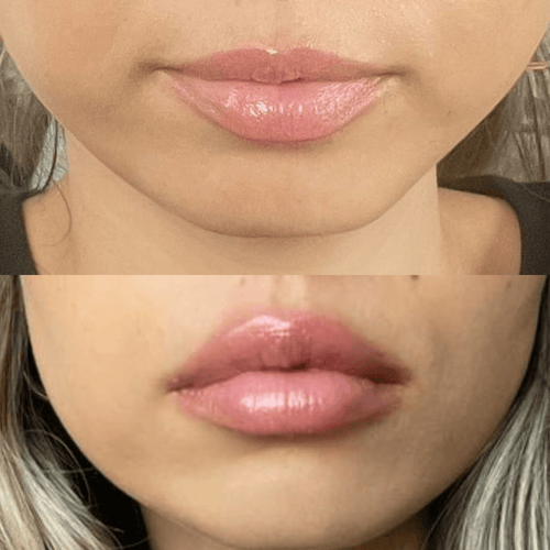 Volumising Lip Plumpler
