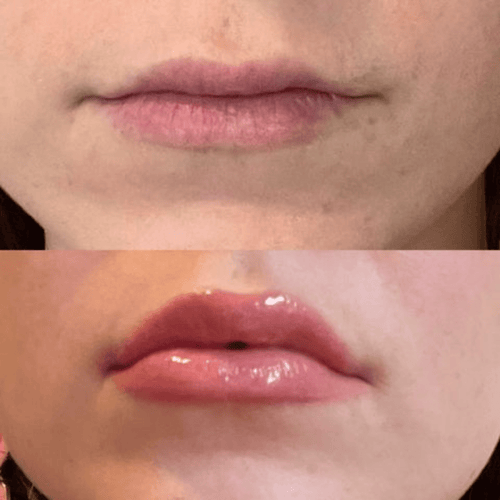 Volumising Lip Plumpler