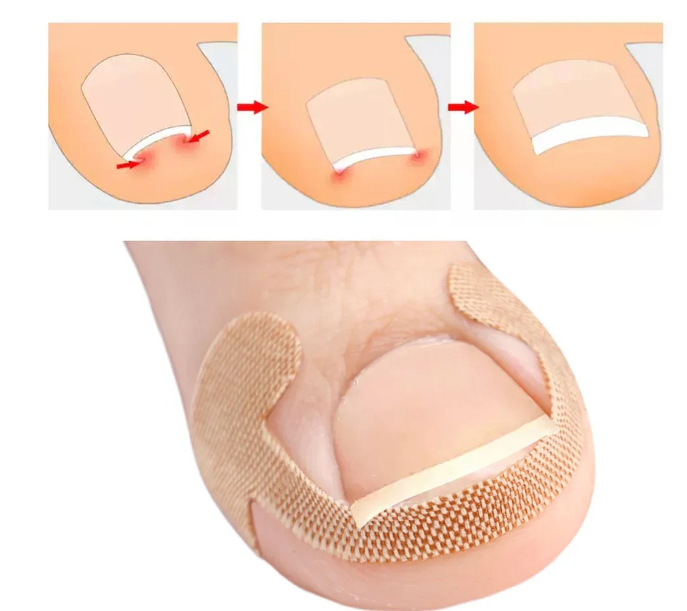 Toenail Correction Strips