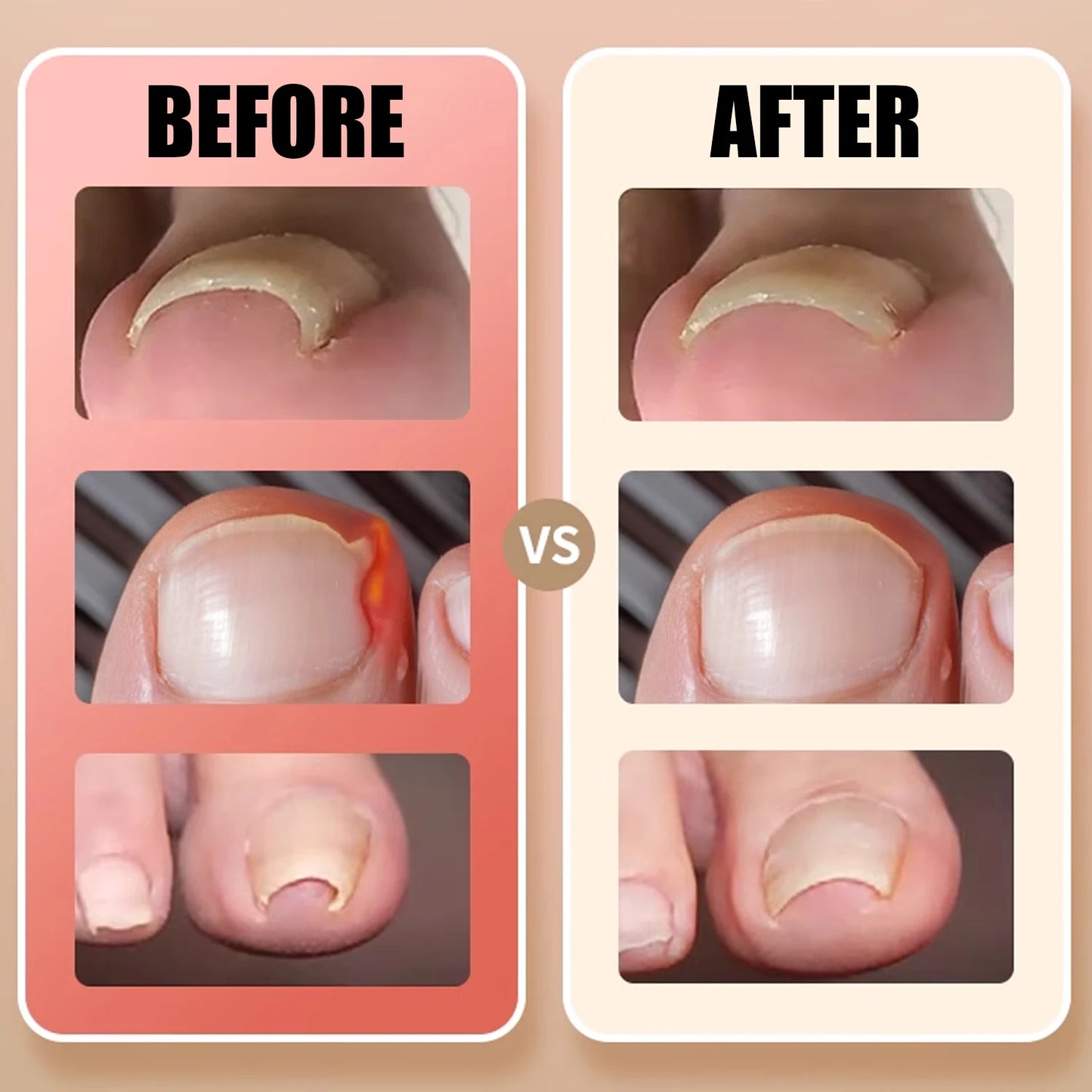 Toenail Correction Strips